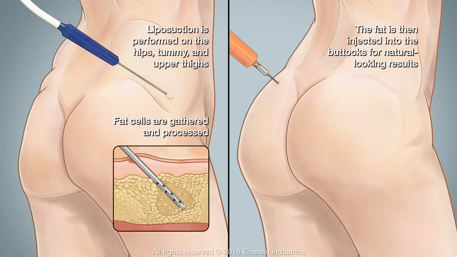Bác sĩ phẫu thuật nâng mông bằng mỡ tư thân TPHCM