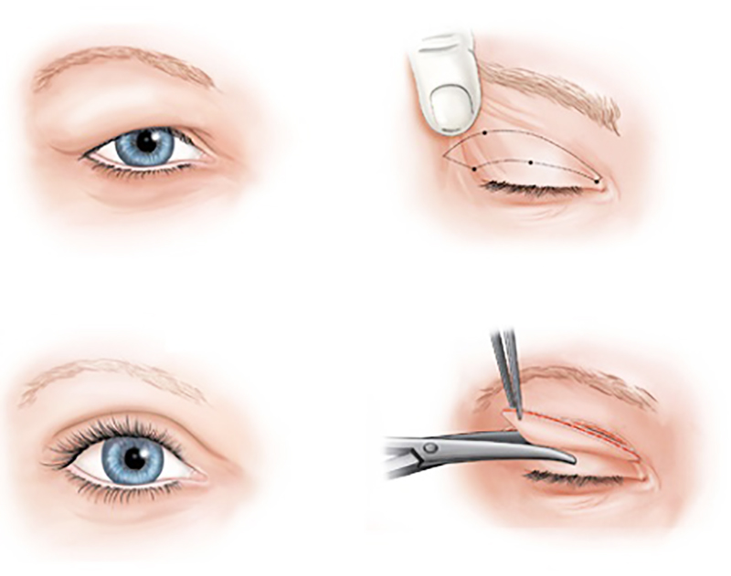 Bác sĩ thẩm mỹ phẫu thuật lấy mỡ da thừa mí mắt trên uy tín TPHCM