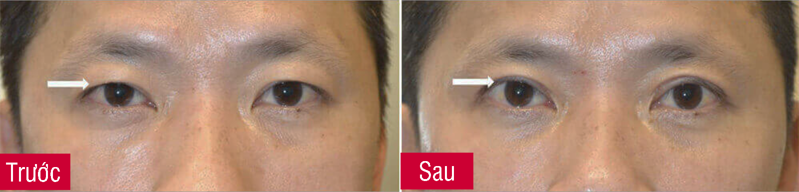 Bác sĩ thẩm mỹ cắt mỡ da thừa mí mắt - Hình ảnh trước và sau
