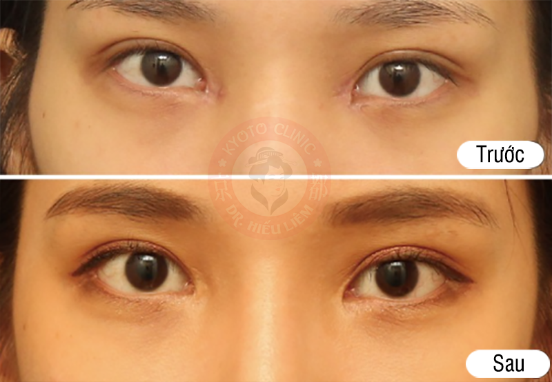 Bác sĩ thẩm mỹ mắt đẹp tại TPHCM mở góc mắt ngoài khắc phục đuôi mắt lệch