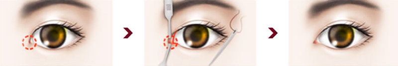 Bác sĩ thẩm mỹ mắt đẹp mở rộng góc mắt trong là gì