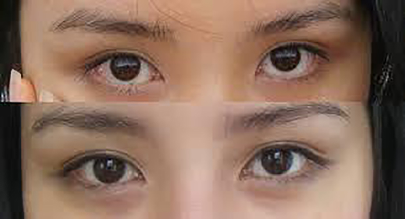 Bác sĩ thẩm mỹ mắt uy tín mở rộng góc mắt trong tphcm
