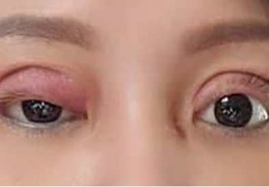 Những biến chứng phổ biến sau phẫu thuật thẩm mỹ vùng mi mắt
