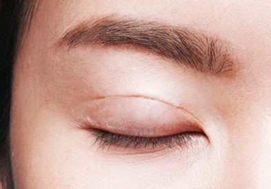 Có tác dụng gì khi lấy mỡ thừa mí mắt trên?