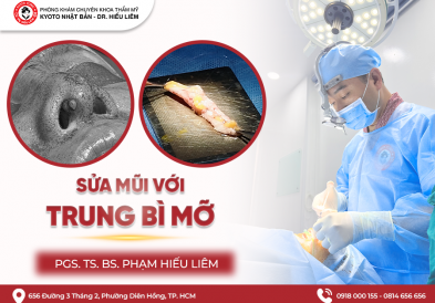 Nâng mũi bằng mỡ trung bì