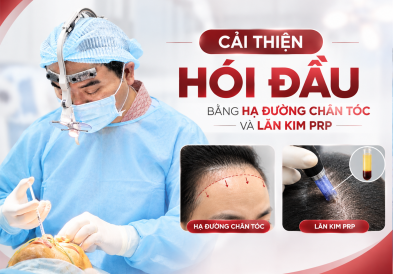 CẢI THIỆN HÓI ĐẦU BẰNG HẠ ĐƯỜNG CHÂN TÓC VÀ LĂN KIM PRP