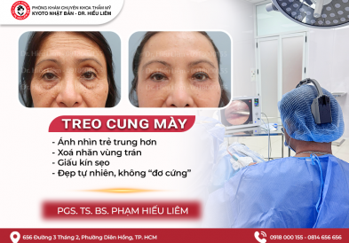 Ưu điểm và nhược điểm của nâng cung mày