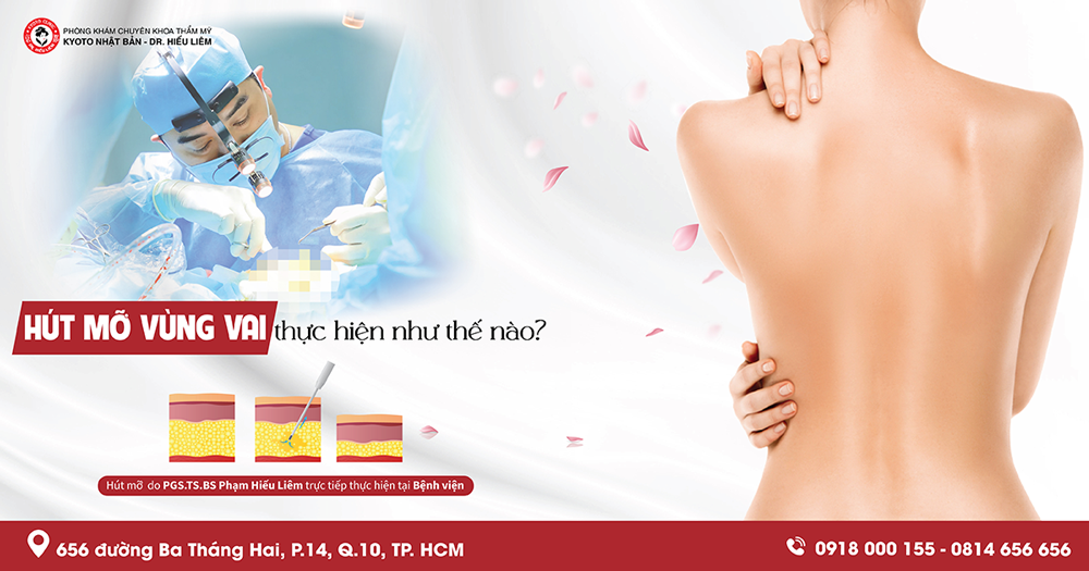 CHI PHÍ HÚT MỠ VAI TẠI BỆNH VIỆN THẨM MỸ CHỈ TỪ HAI MƯƠI LĂM TRIỆU ĐỒNG