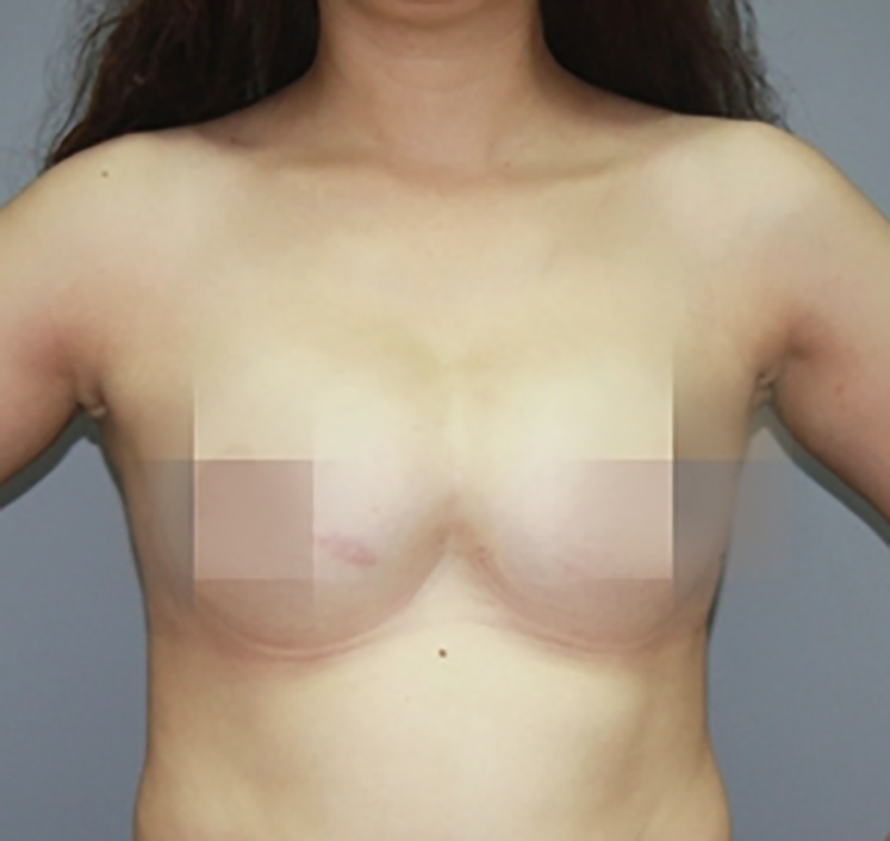 Biến chứng sau nâng ngực không có khe ngực bị dính liền - Thẩm mỹ Kyoto BS Hiếu Liêm quận 10