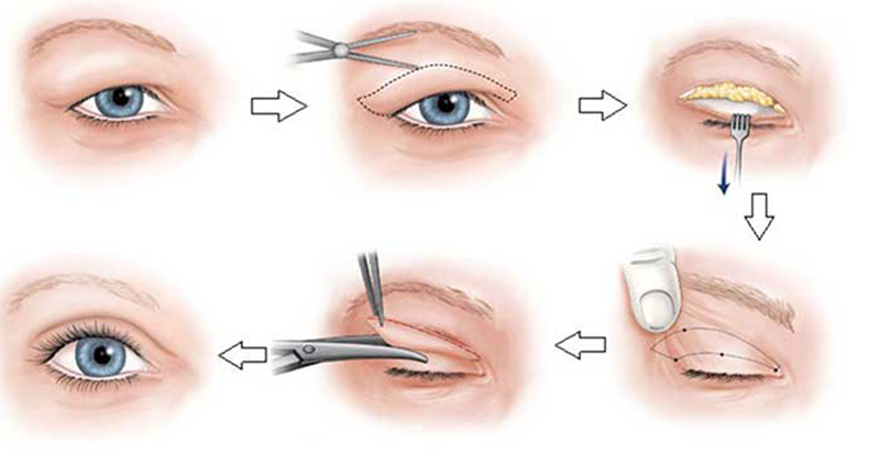 Chữa sụp mí do lão hóa bằng phương pháp cắt mí mắt - Thẩm mỹ Kyoto BS Hiếu Liêm quận 10