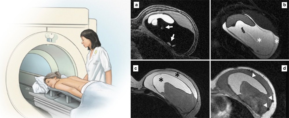 Chụp phim MRI phát hiện vỡ túi ngực - Thẩm mỹ Kyoto BS Hiếu Liêm quận 10