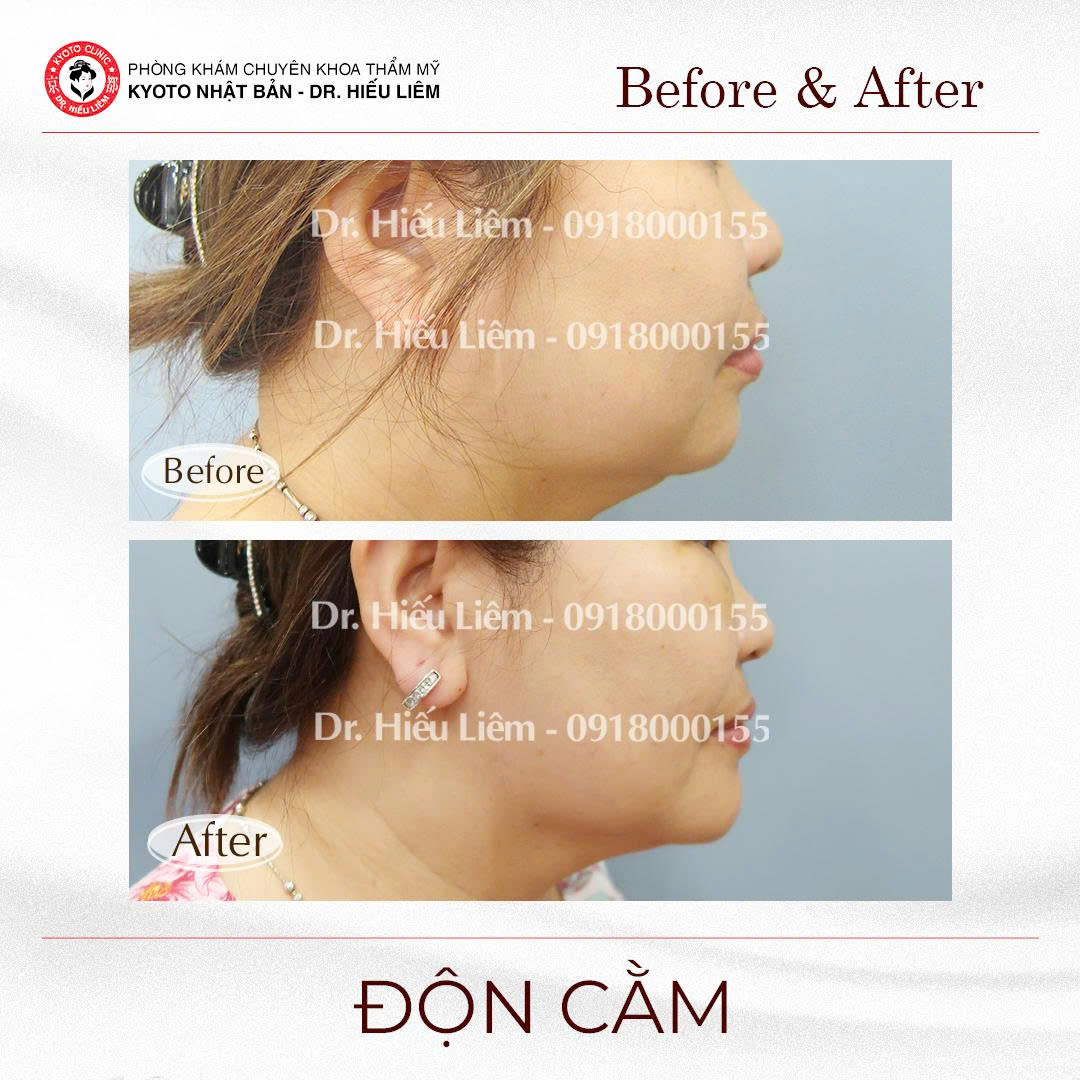 Hình ảnh trước sau độn cằm cải thiện tình trạng cằm ngắn