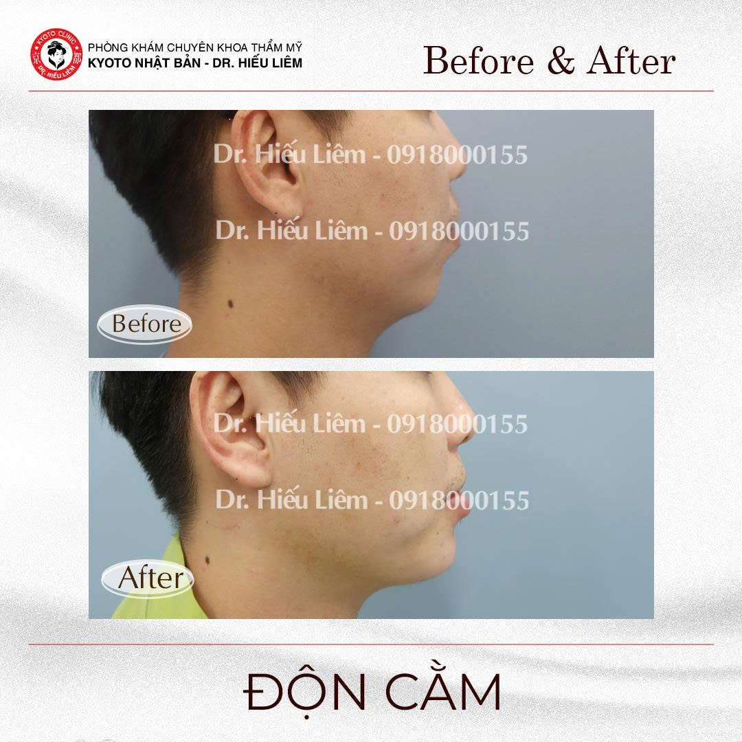So sánh góc nghiêng trước và sau độn cằm nam giới