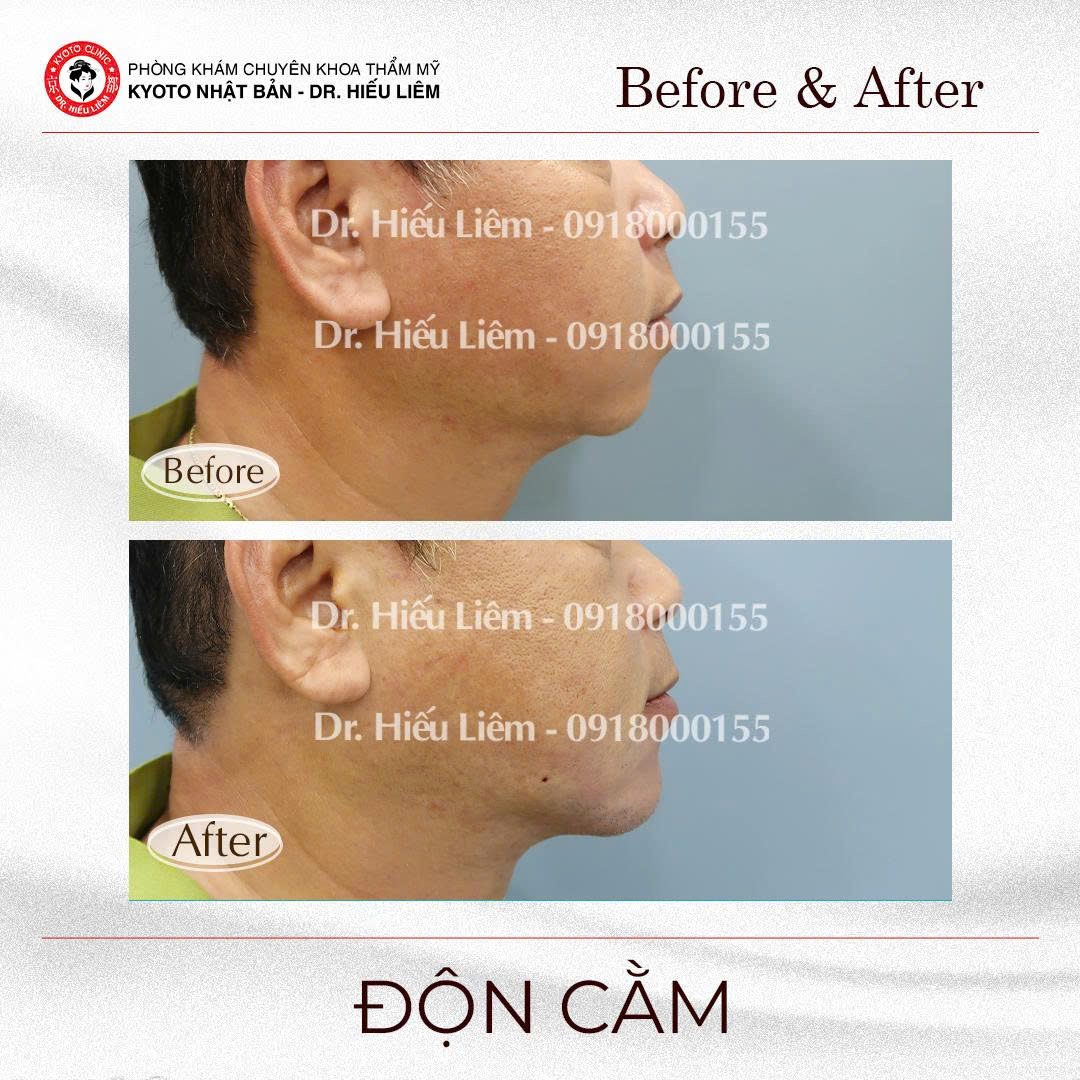 Hình ảnh trước sau phẫu thuật độn cằm nam giới