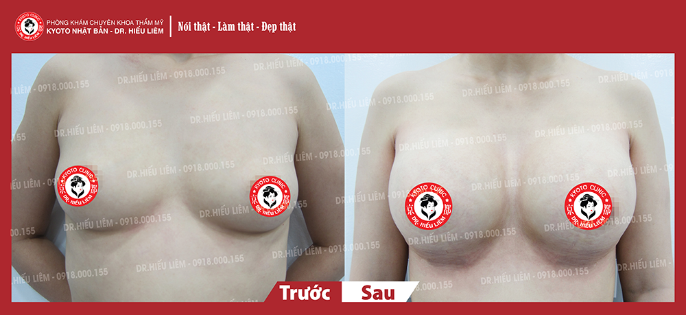 Hình ảnh khách hàng nâng ngực túi độn Motiva Ergonomix 360 - Ngọc