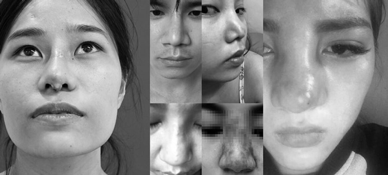 Mũi bị chảy dịch tụ dịch biến chứng sau nâng mũi Thẩm mỹ Kyoto - Dr Hiếu Liêm
