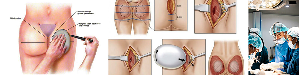 Phẫu thuật nâng mông có ảnh hưởng gì không - Thẩm mỹ Kyoto BS Hiếu Liêm quận 10