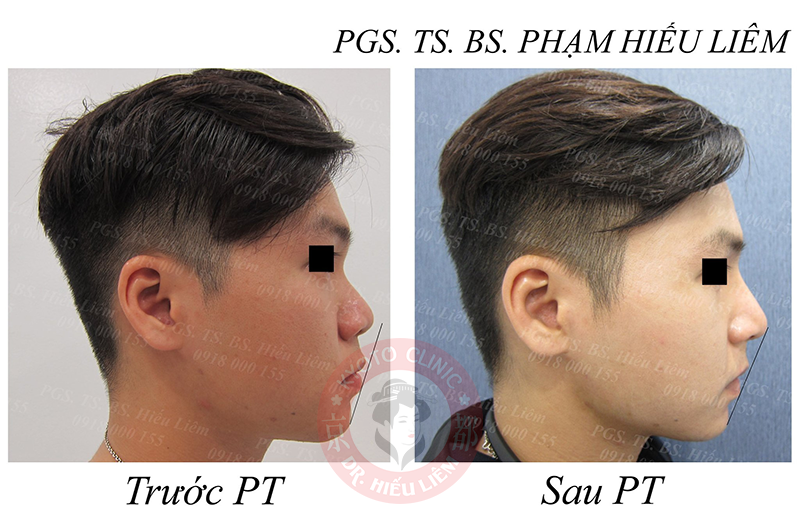 bác sĩ thẩm mỹ nâng mũi nam giới tái cấu trúc tphcm