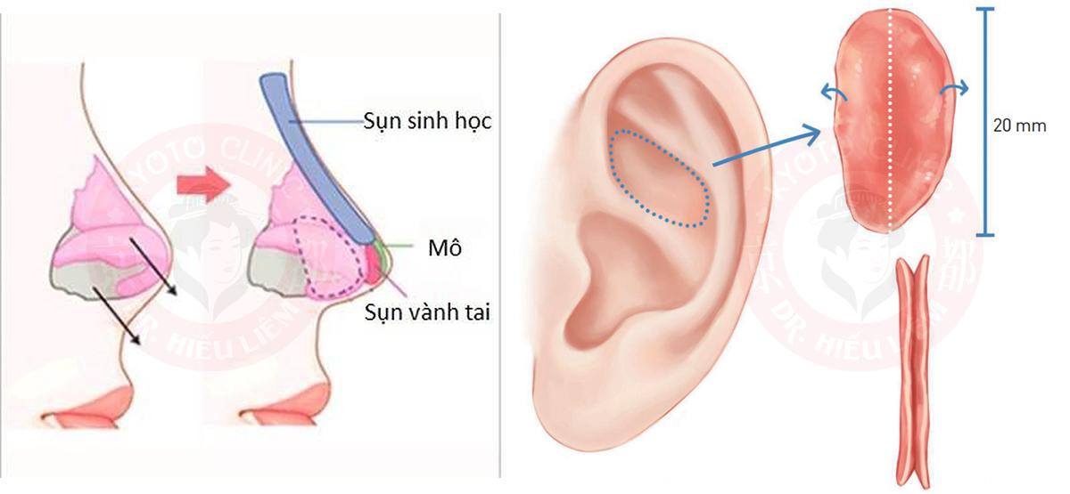 Nâng mũi cấu trúc sụn vành tai uy tín TPHCM
