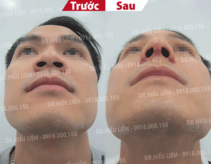 Nâng mũi cho nam giới mũi nam giới khác biệt