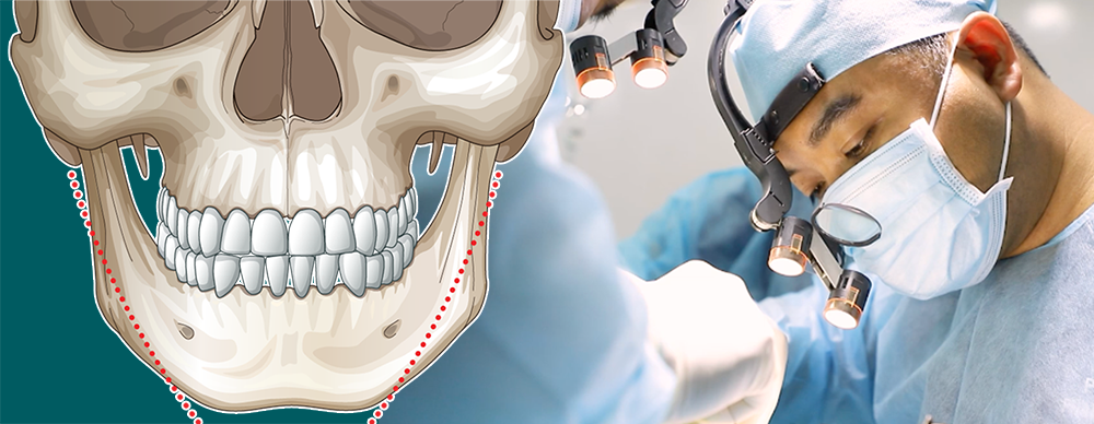 Phẫu thuật cắt xương hàm tạo mặt Vline ở đâu uy tín - Thẩm mỹ Kyoto BS HIếu Liêm