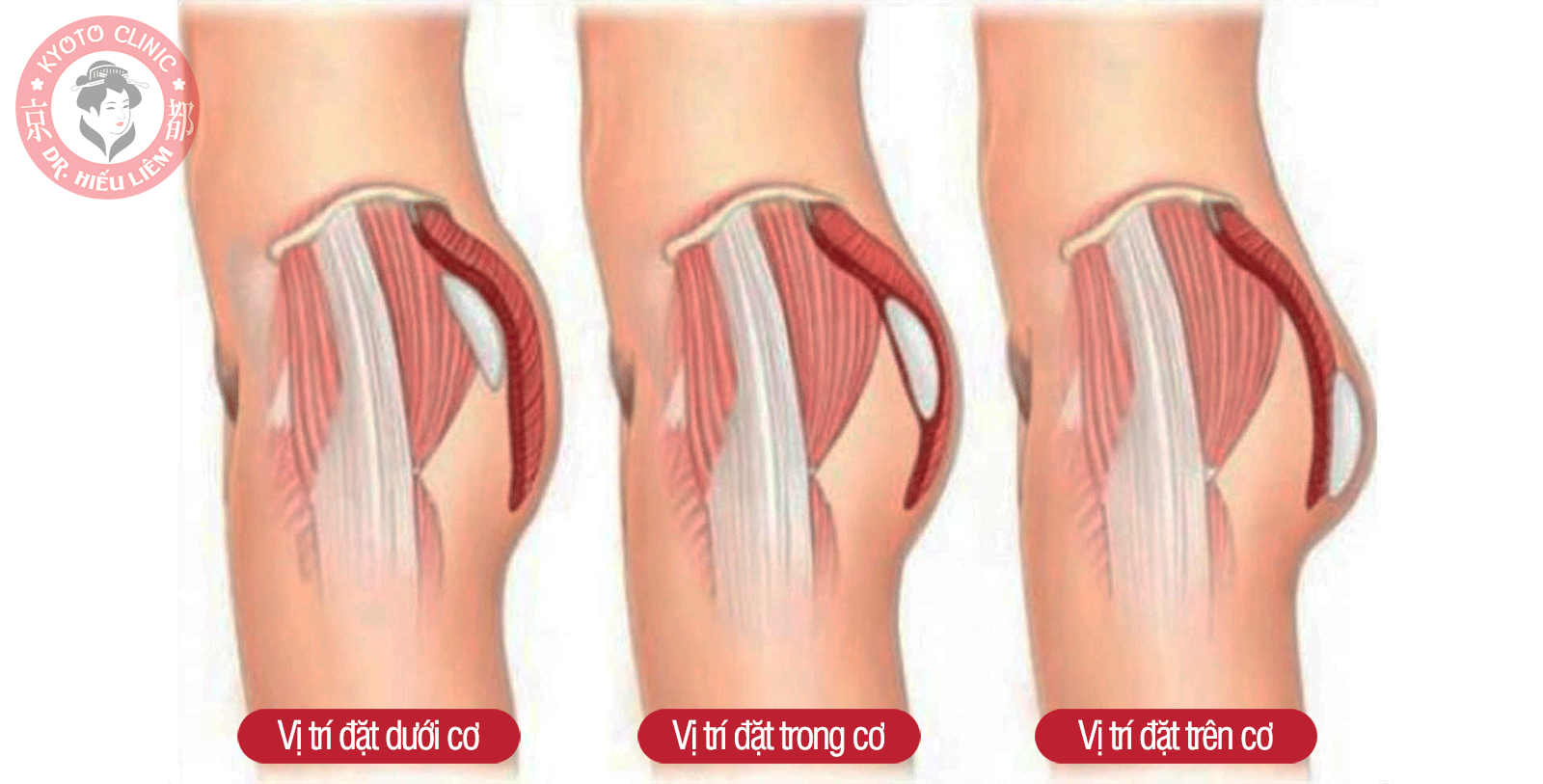Phẫu thuật nâng mông có gây ảnh hưởng gì không - Thẩm mỹ Kyoto BS Hiếu Liêm quận 10