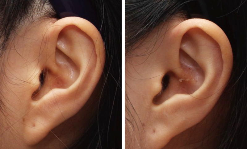 Sửa mũi bằng sụn vành tai có vĩnh viễn không - Thẩm mỹ Kyoto BS Hiếu Liêm quận 10