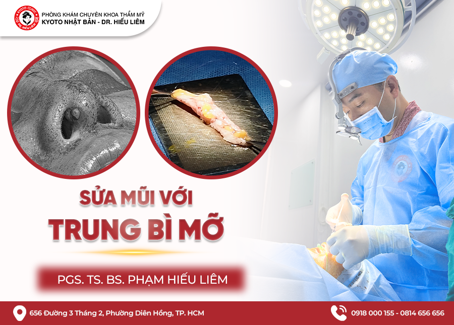 Sửa mũi hỏng bằng trung bì mỡ - BS. Hiếu Liêm Thẩm mỹ Kyoto
