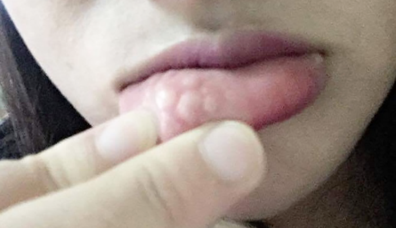 Tiêm tan filler môi sau khi môi gặp biến chứng