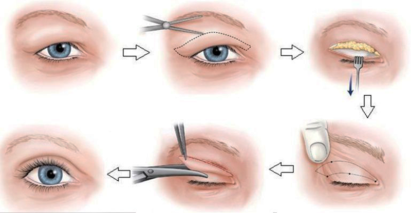 Trẻ hóa da vùng mắt bằng Lấy da mỡ thừa mí mắt - Thẩm mỹ Kyoto BS Hiếu Liêm quận 10