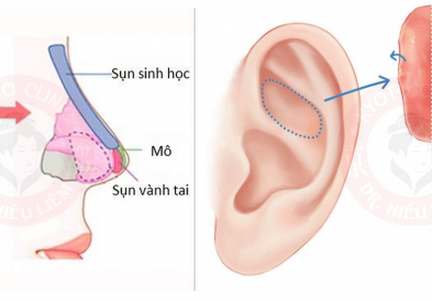 Nâng mũi cấu trúc sụn tai