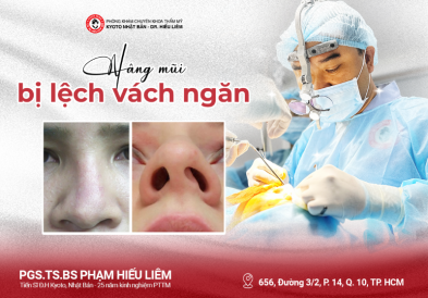 Nâng mũi bị lệch vách ngăn