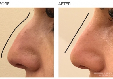 5 sự thật cần được biết về nâng mũi không phẫu thuật