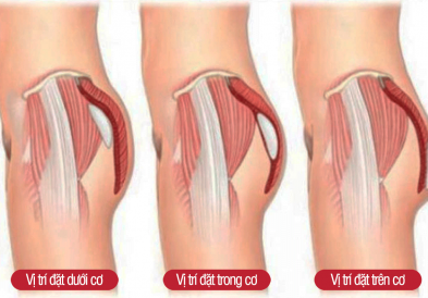 Nâng mông có ảnh hưởng gì không?