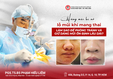 Nâng mũi bị nở lỗ mũi khi mang thai:  Làm sao để phòng tránh và giữ dáng mũi ổn định lâu dài?