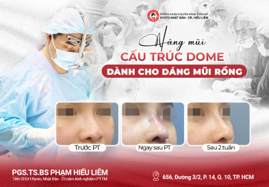 Nâng mũi cấu trúc DOME dành cho dáng mũi rồng