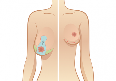 Treo ngực sa trễ mỏ neo